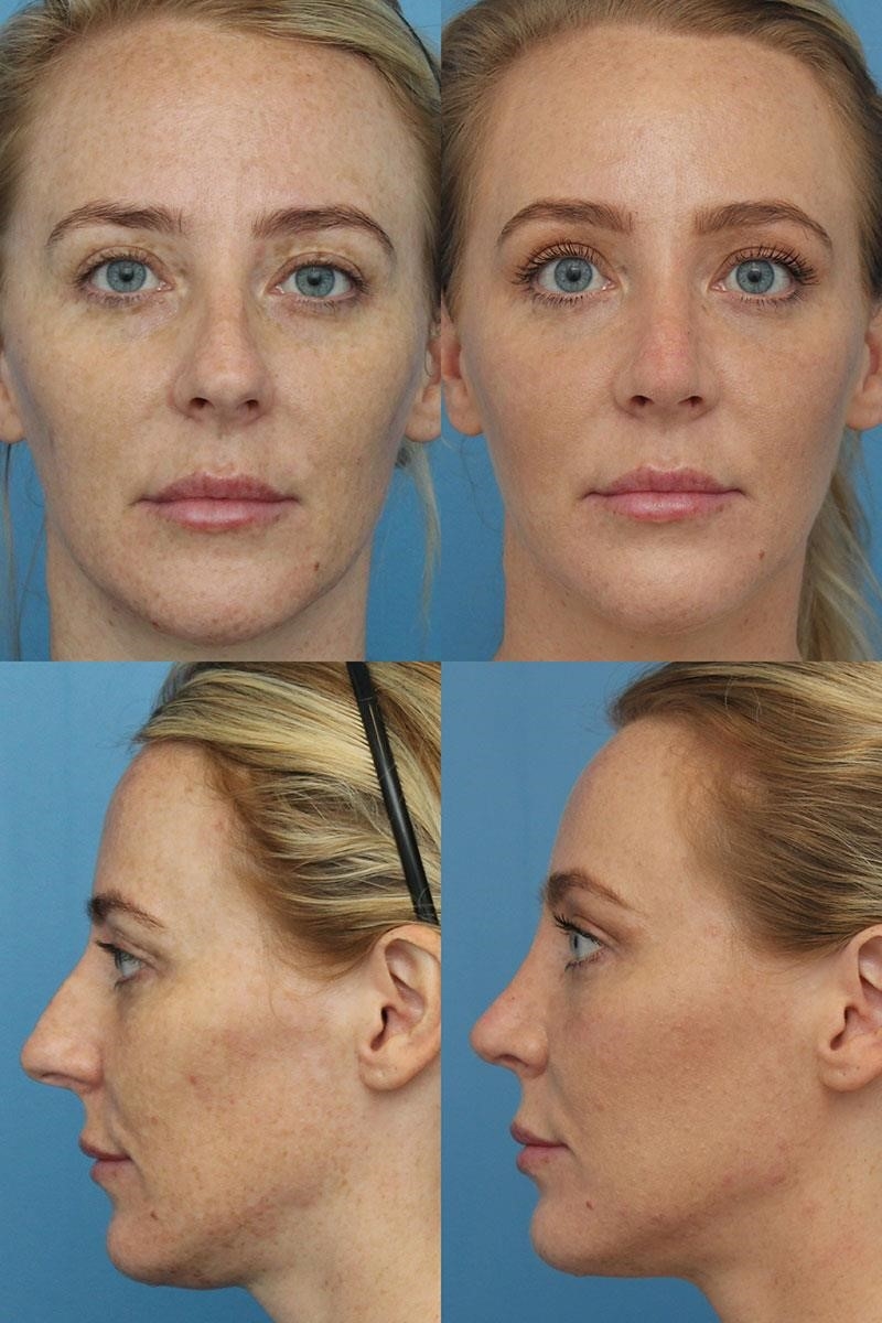 rhinoplasty surgeons near me