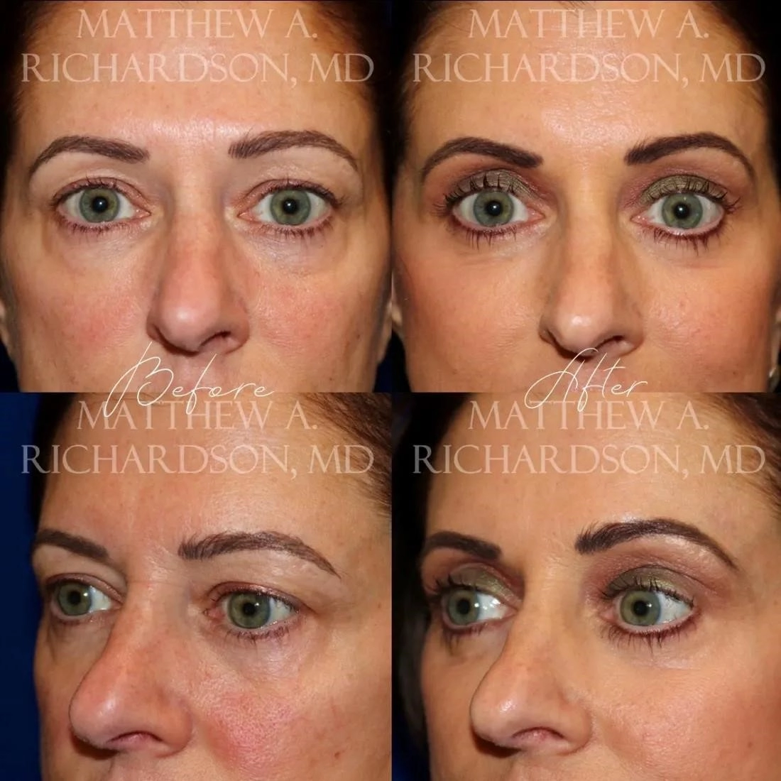 rhinoplasty surgery