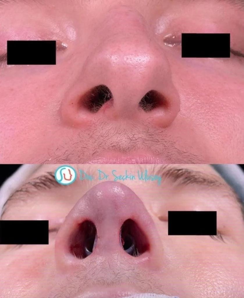 rhinoplasty surgery