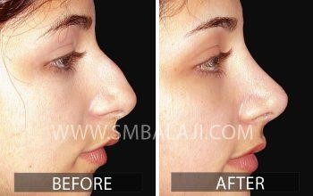 rhinoplasty surgeons near me